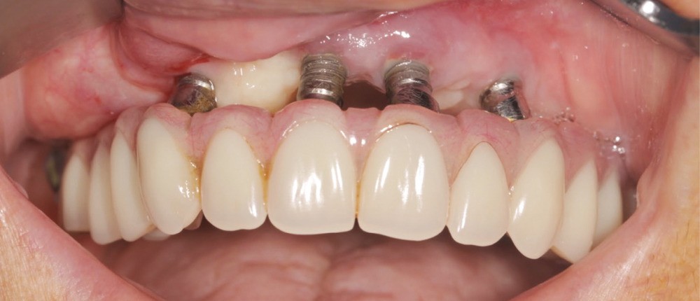 échec implants dentaire Santa catarina