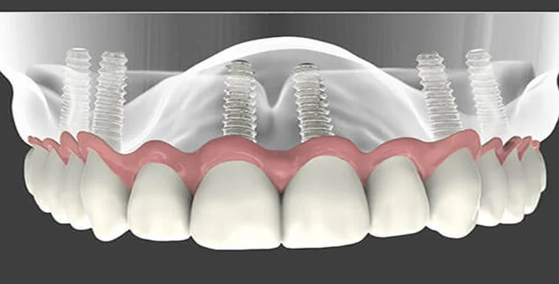 echec implantologie dentaire santa catarina